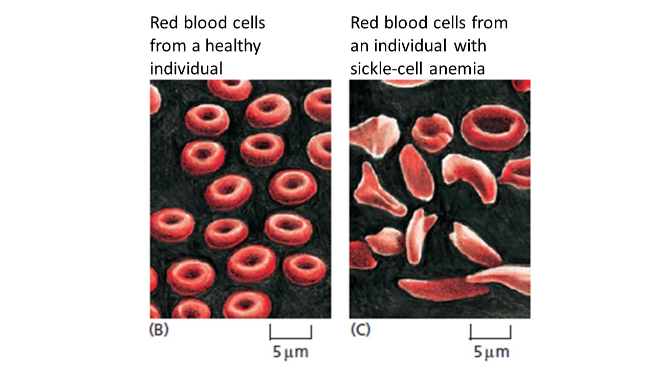 misshapen red blood cells